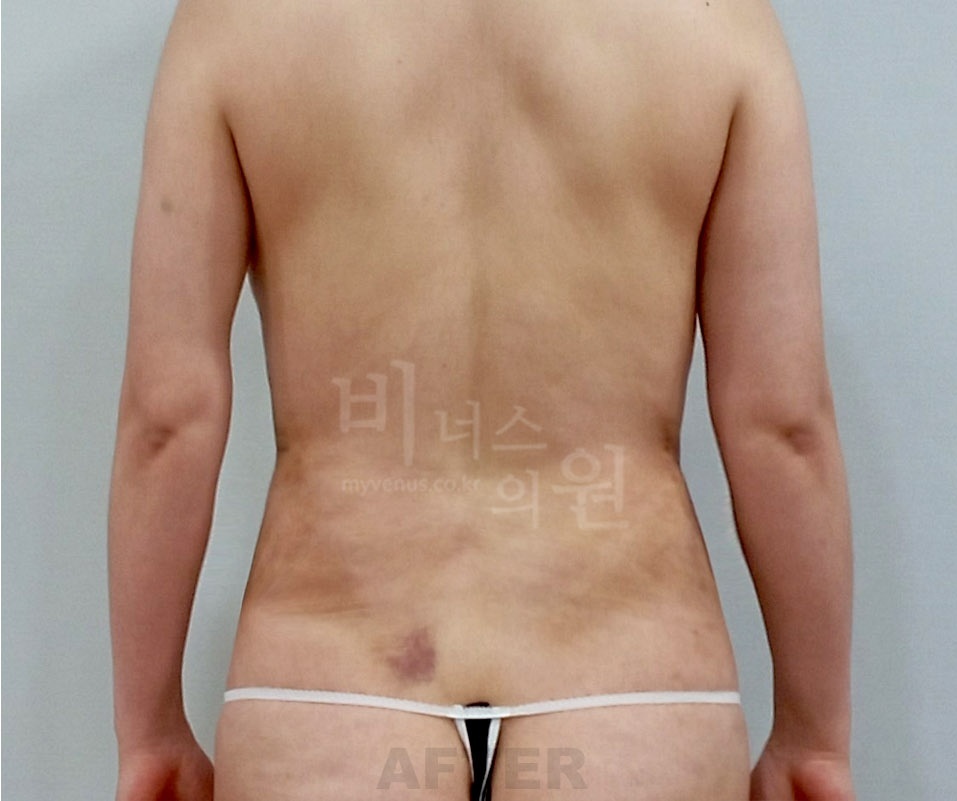 복부 지방흡입 수술 후 후면 사진 - 비너스의원 2023년 촬영 동일인, 아랫배와 허리 윤곽 비교