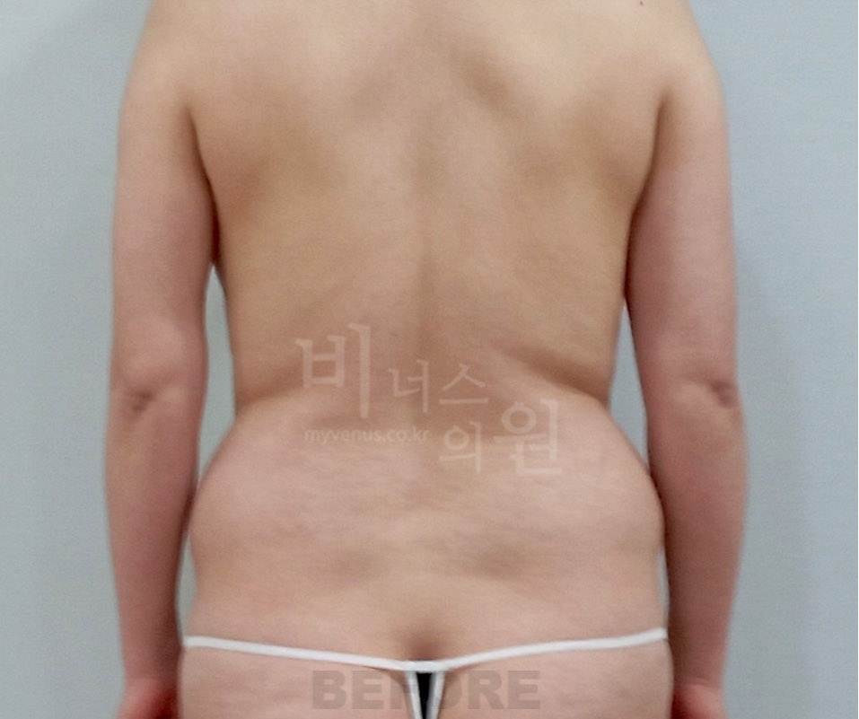 복부 지방흡입 수술 전 후면 사진 - 비너스의원 2023년 촬영 동일인, 아랫배와 허리 윤곽 비교