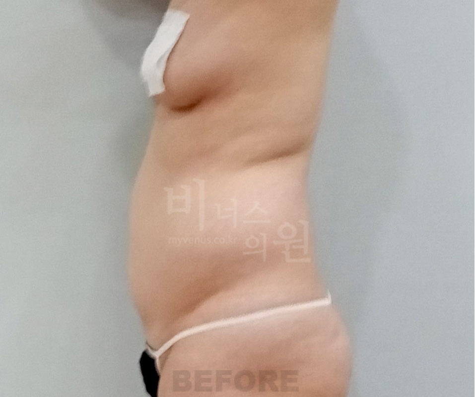 복부 지방흡입 수술 전 측면 사진 - 비너스의원 2023년 촬영 동일인, 아랫배와 허리 윤곽 비교