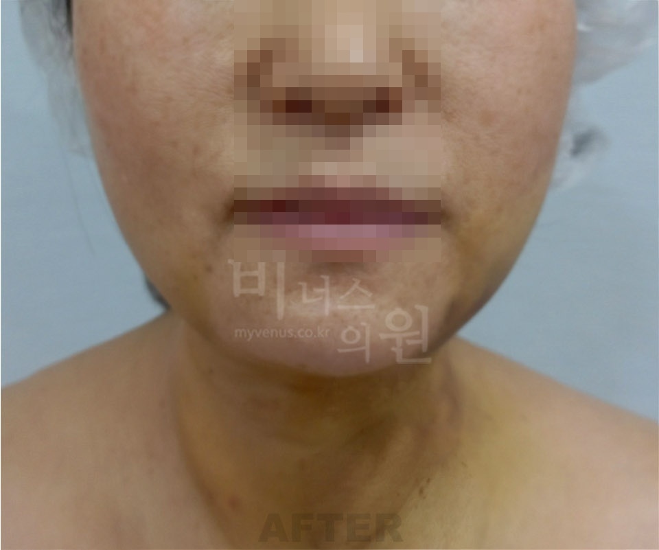 얼굴·턱·목 수술 후 정면 사진 - 턱선과 목 라인 확인