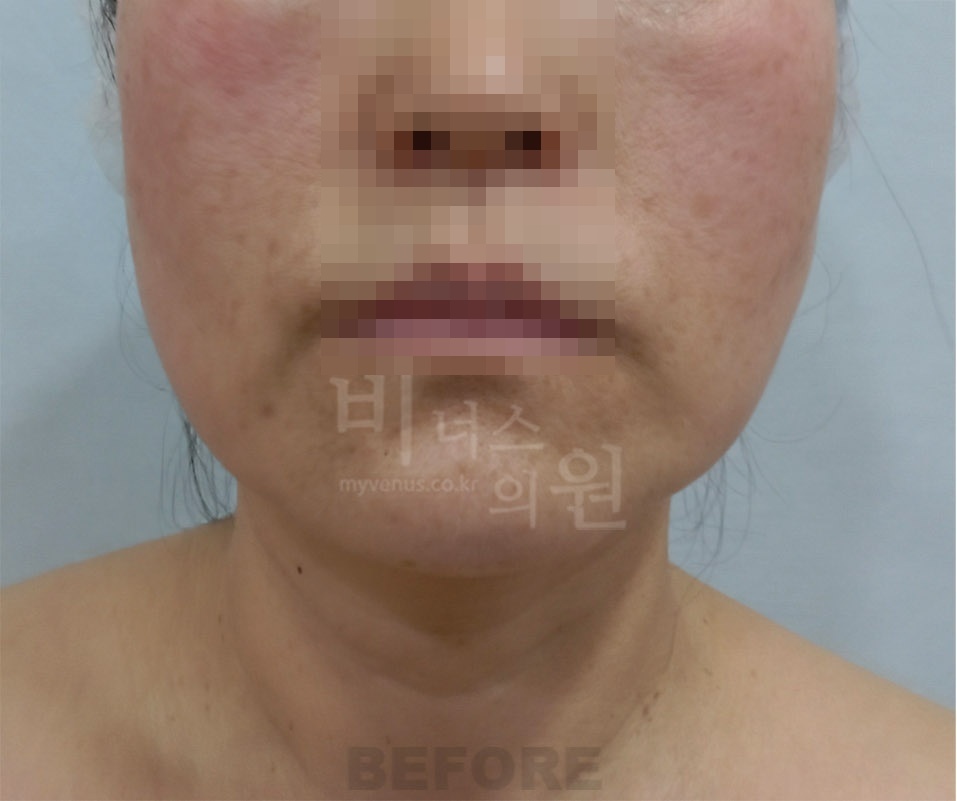 얼굴·턱·목 수술 전 정면 사진 - 턱선과 목 라인 확인
