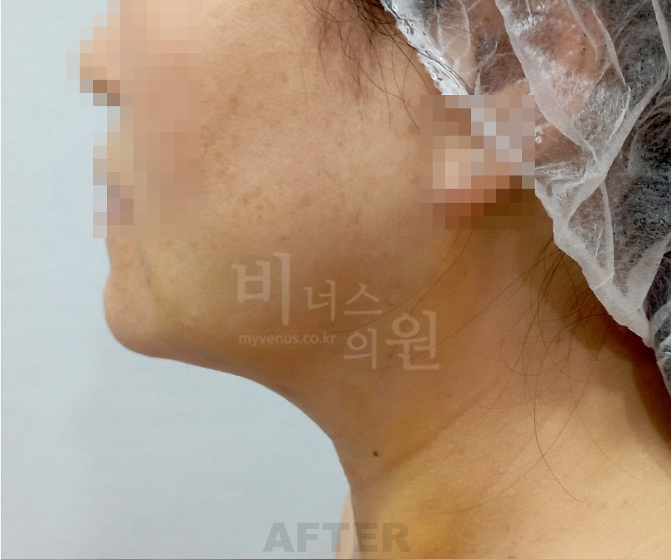 얼굴·턱·목 수술 후 좌측면 사진 - 턱선과 목 라인 확인