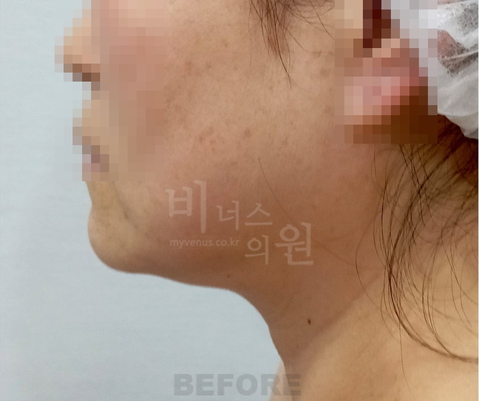 얼굴·턱·목 수술 전 좌측면 사진 - 턱선과 목 라인 확인
