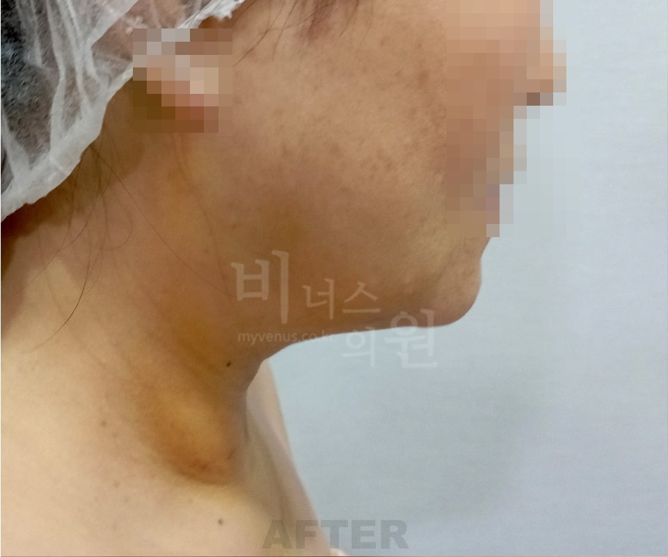 얼굴·턱·목 수술 후 우측면 사진 - 턱선과 목 라인 확인