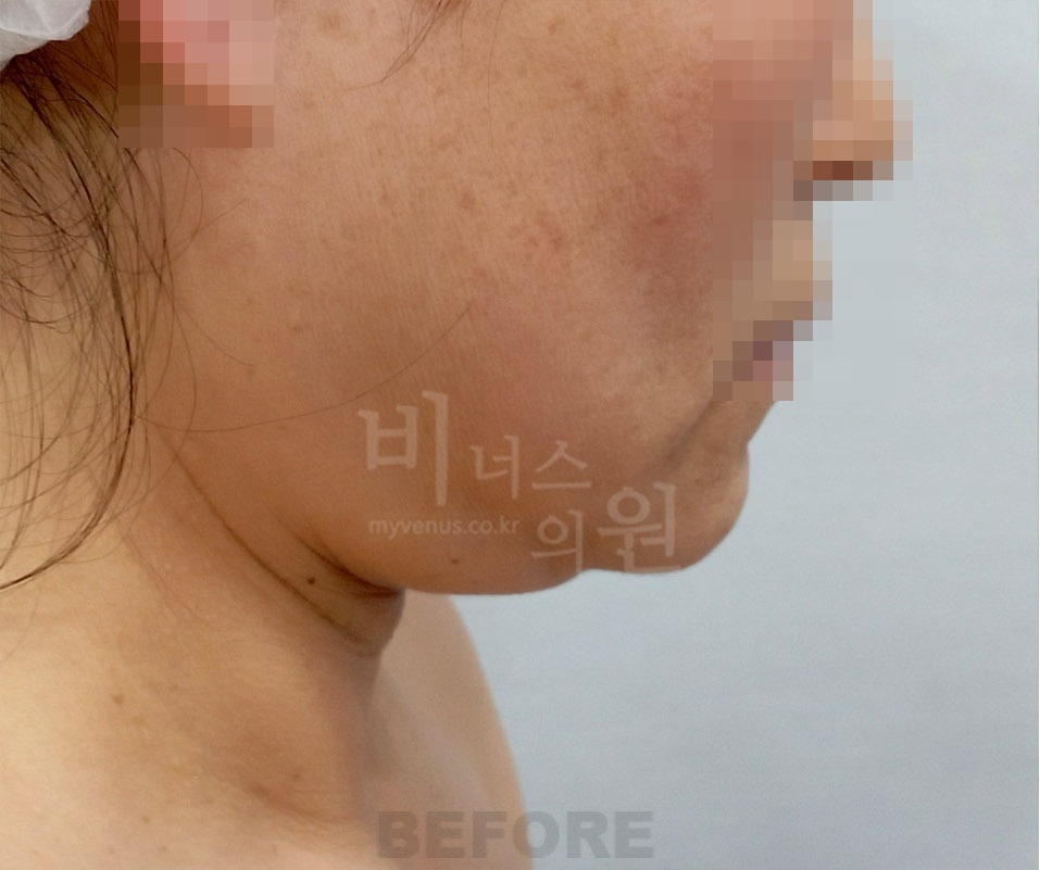 얼굴·턱·목 수술 전 우측면 사진 - 턱선과 목 라인 확인