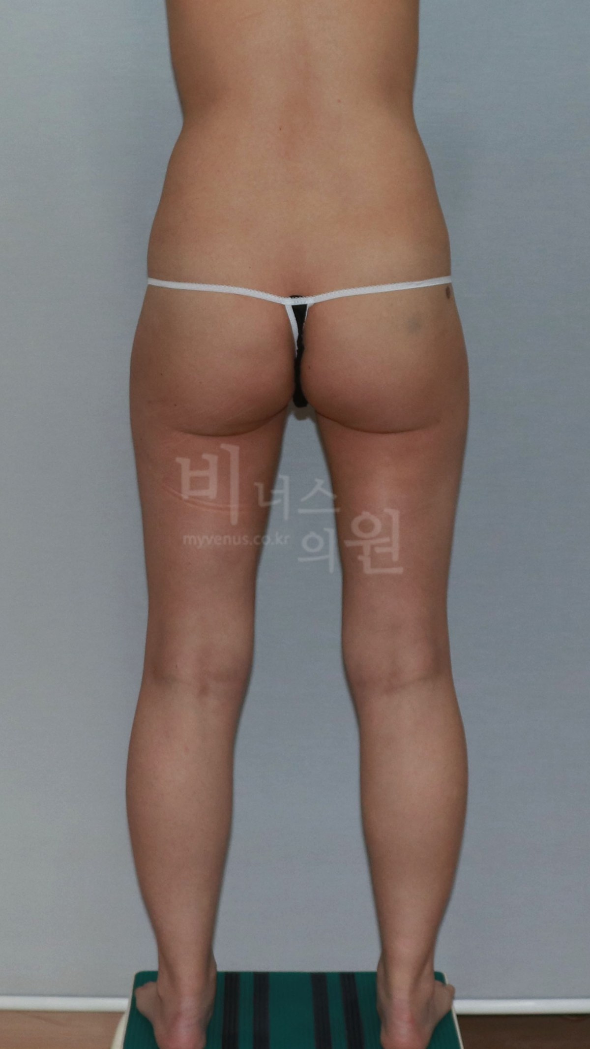 엉덩이 지방흡입 수술 전 후면 사진 두 번째 - 엉덩이 하방 윤곽과 좌우 모습