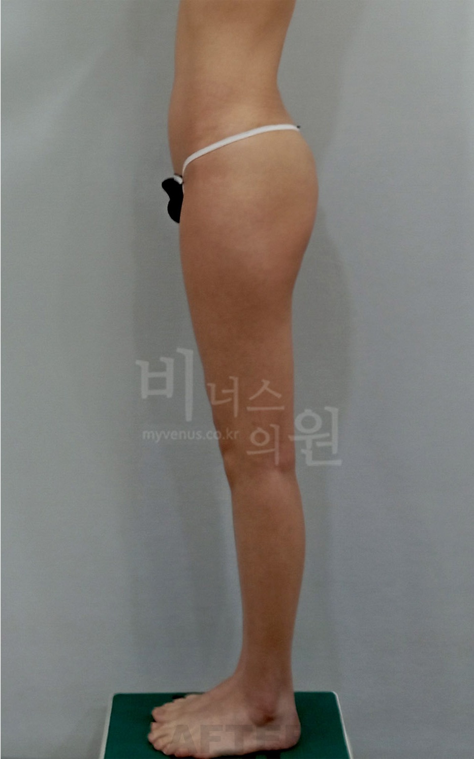 엉덩이 지방흡입 수술 후 좌측면 사진 - 비너스의원 2022년 촬영 동일인