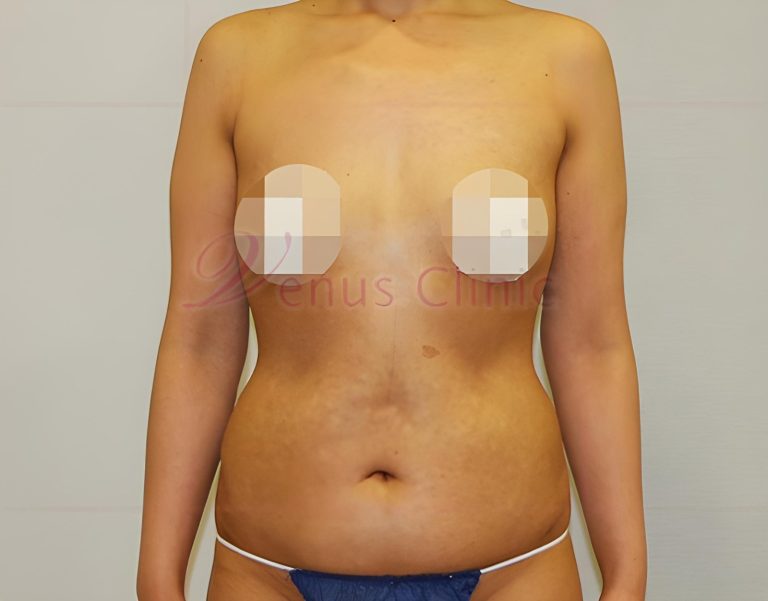 복부지방흡입 석 달 뒤부터가 진짜 관리입니다 — 체중이 오르내릴 때 살은 어디에 붙는지, 한 달 단위 점검표로 정리했습니다
