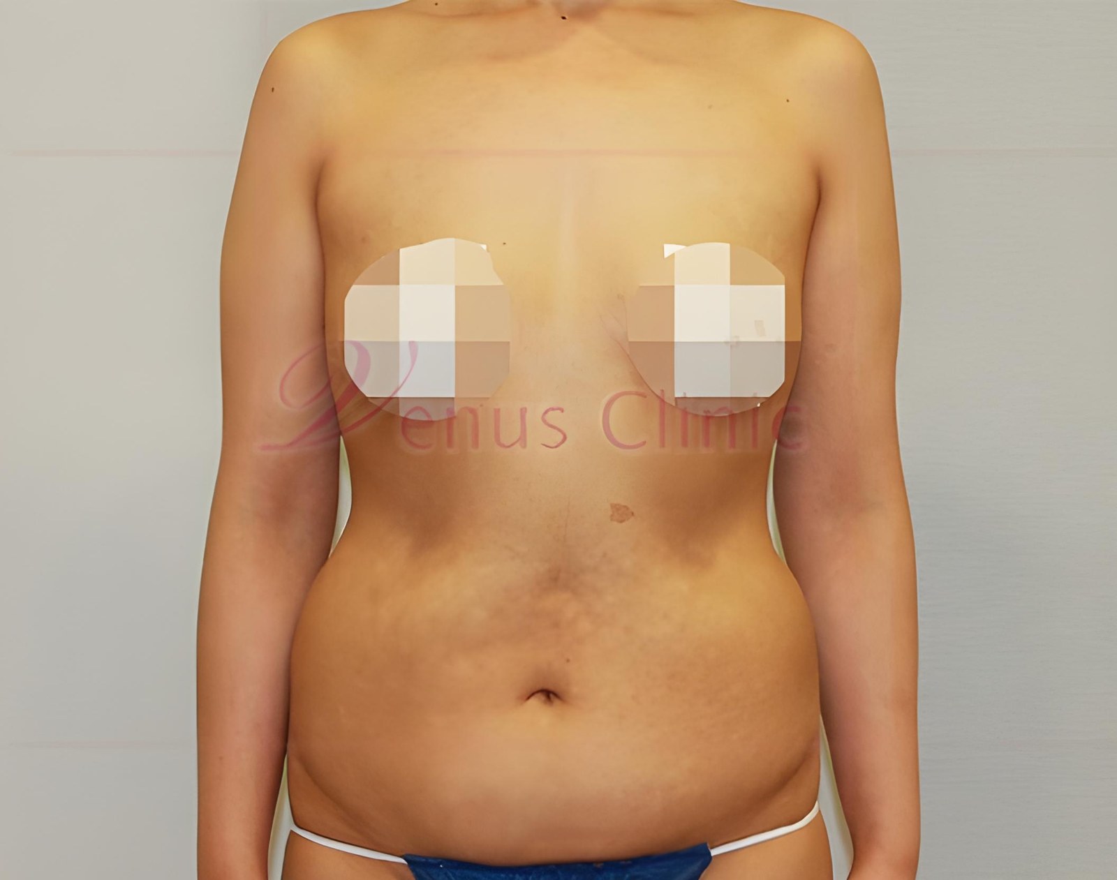 복부지방흡입 수술 전 정면 사진 — 체중감량 후 하복부 좌우 윤곽