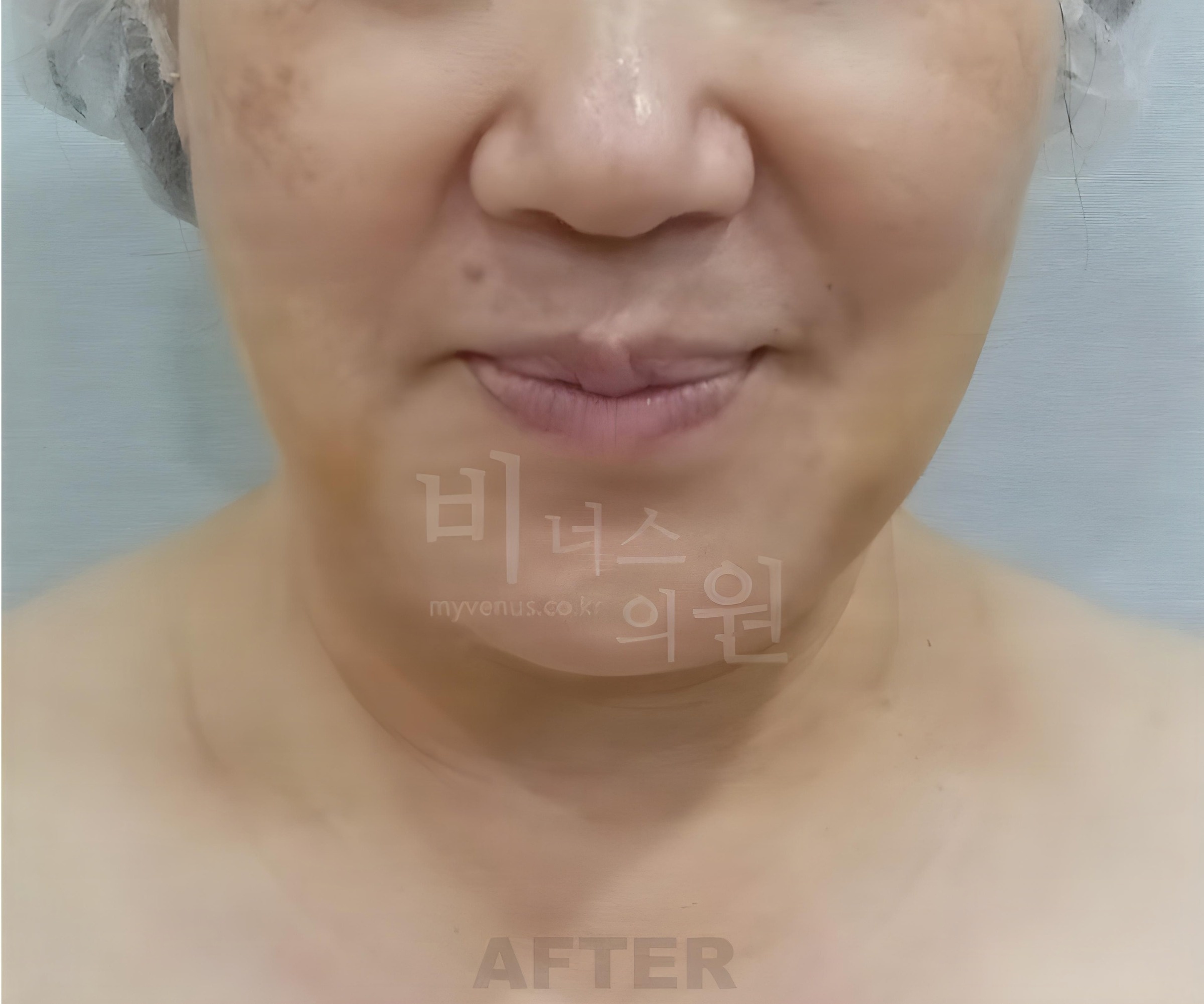 이중턱·턱라인 지방흡입 수술 후 1주 경과 정면 (50대 중후반 여성)