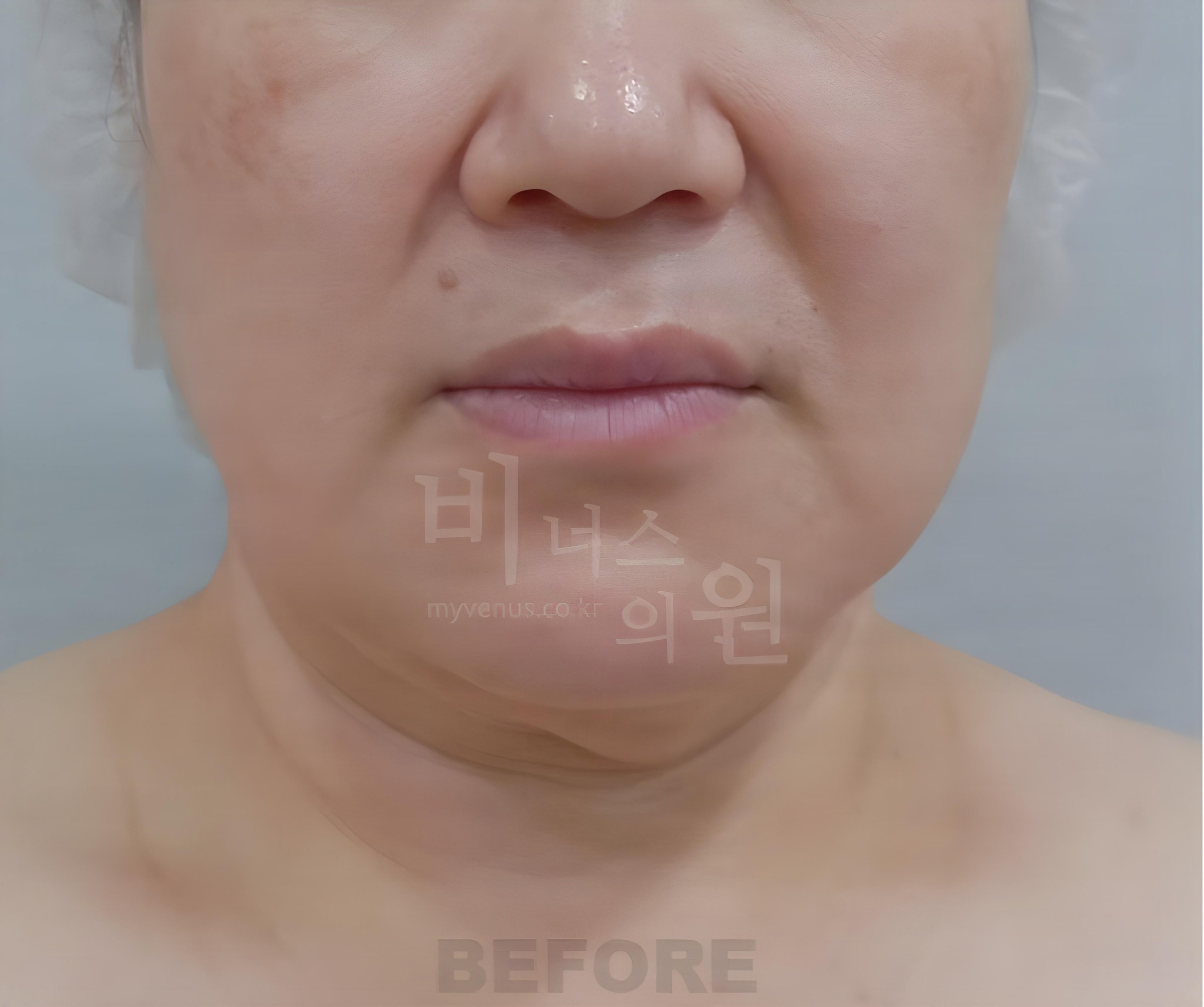 이중턱·턱라인 지방흡입 수술 전 정면 (50대 중후반 여성)