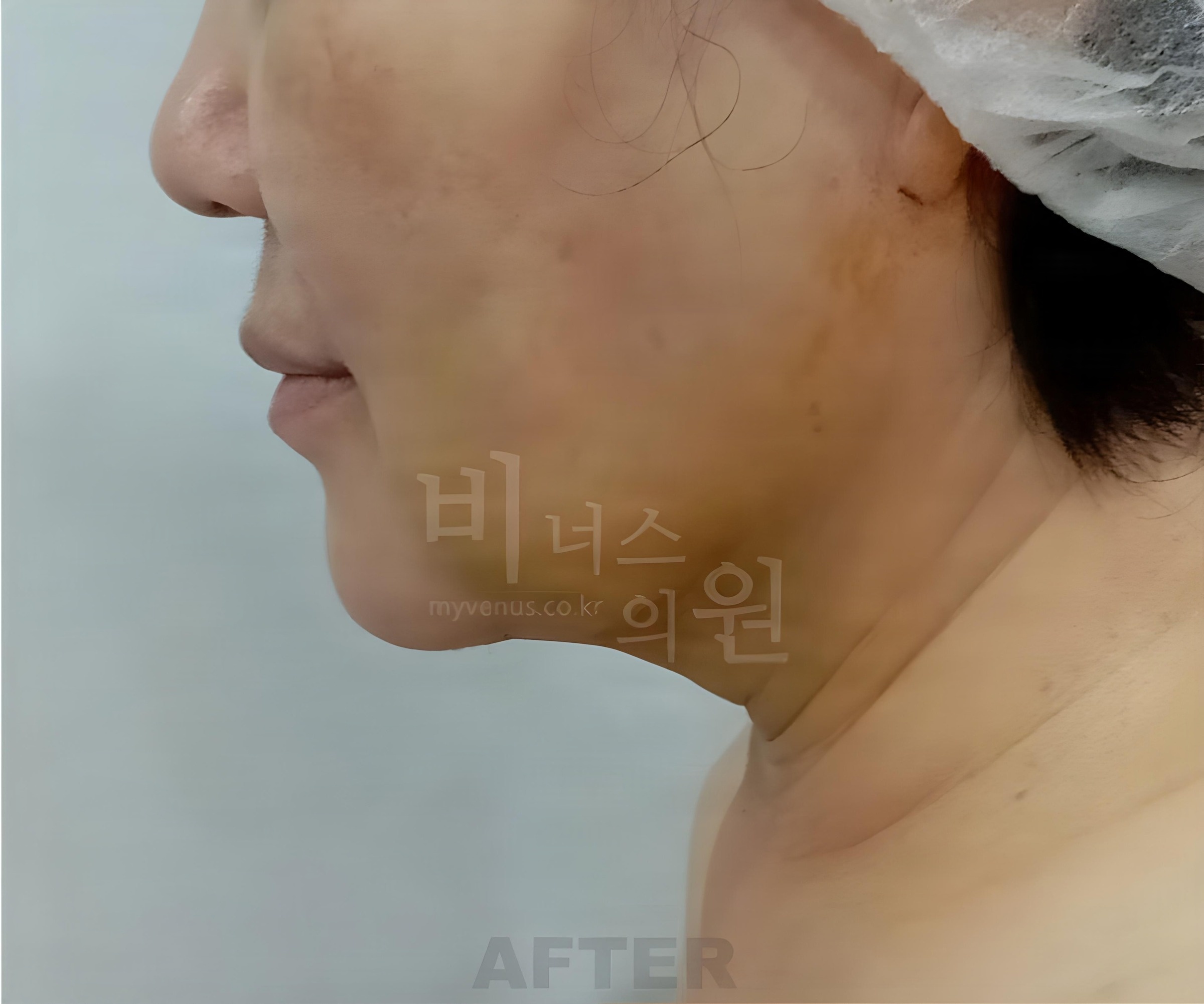 이중턱·턱라인 지방흡입 수술 후 1주 경과 측면 (50대 중후반 여성)