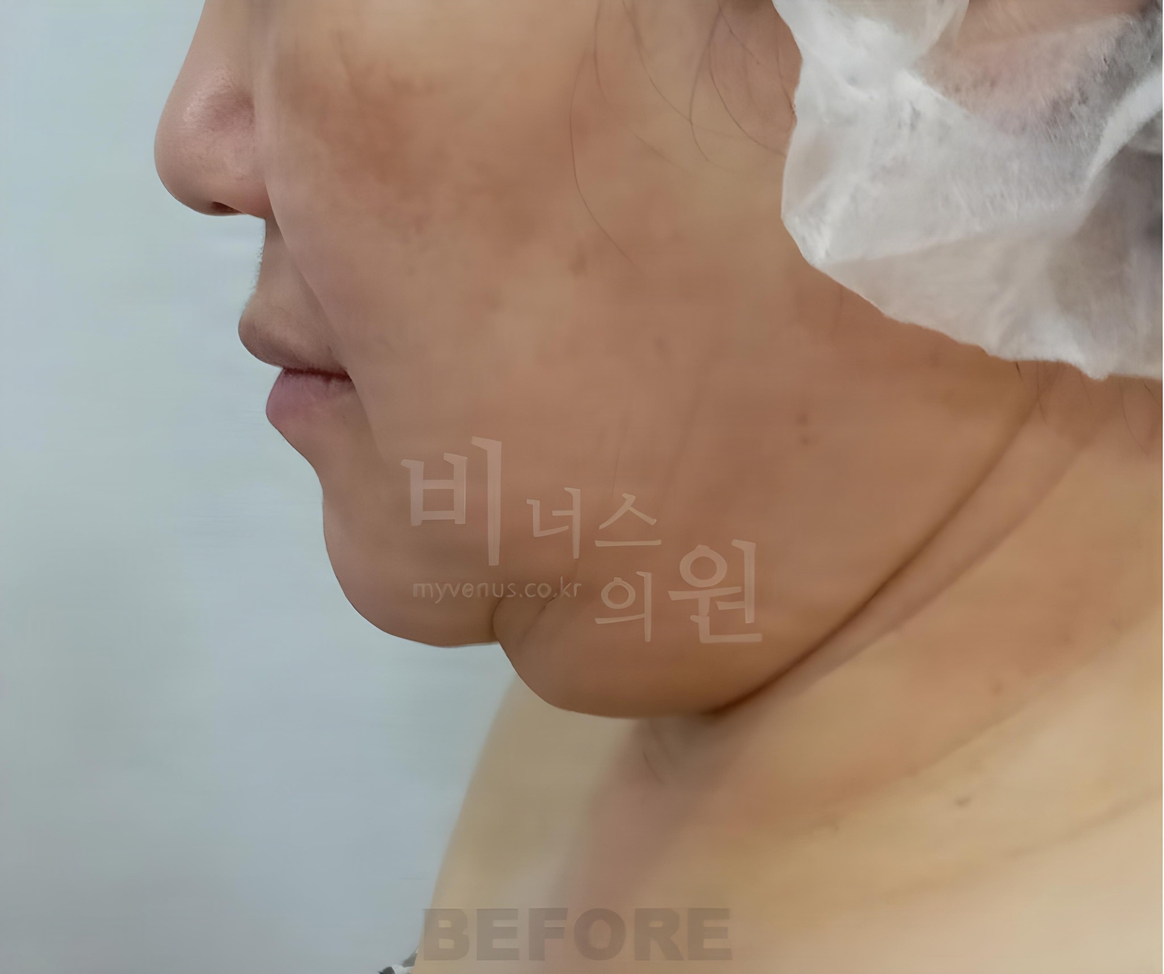 이중턱·턱라인 지방흡입 수술 전 측면 (50대 중후반 여성)