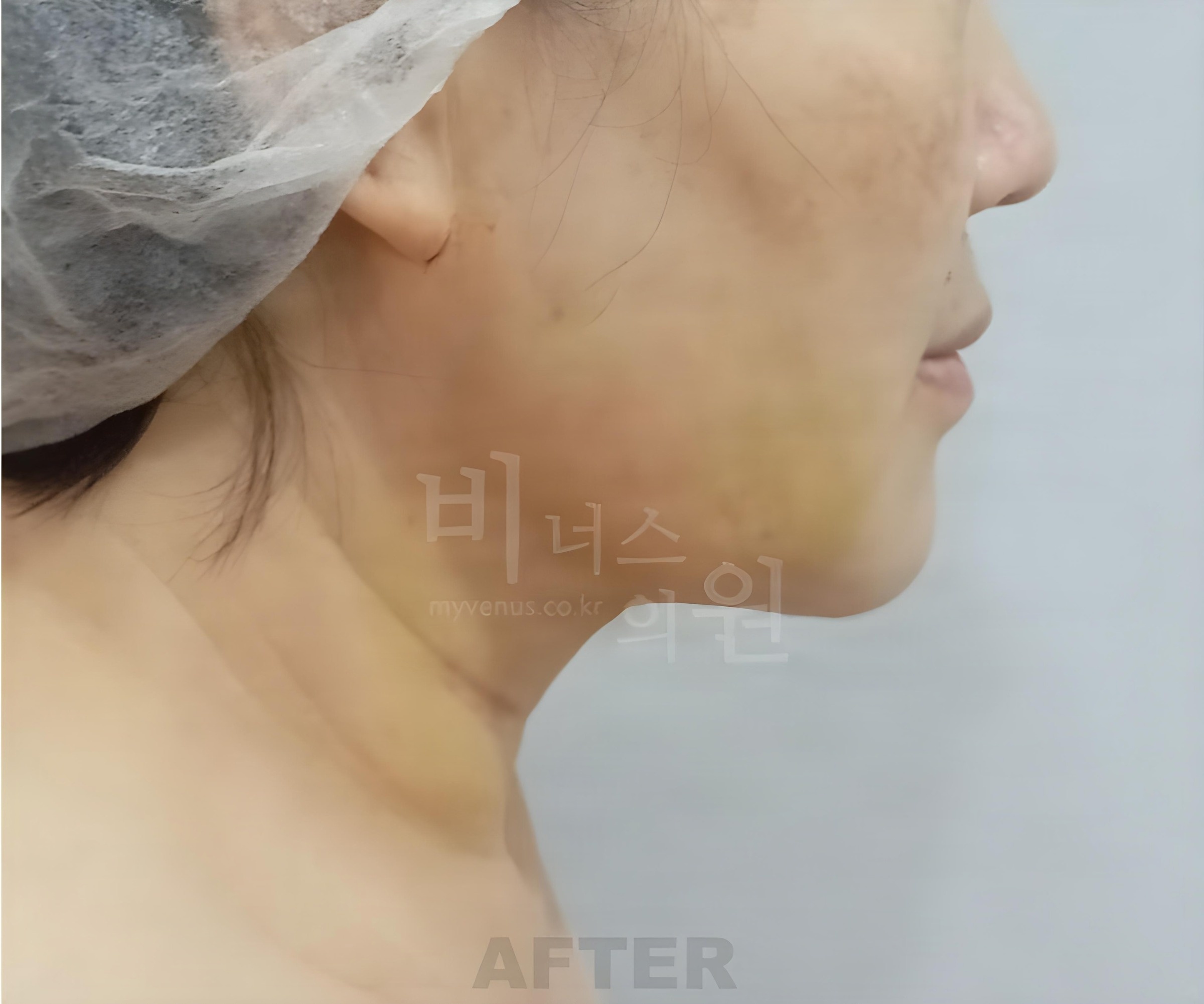 이중턱·턱라인 지방흡입 수술 후 1주 경과 반대편 측면 (50대 중후반 여성)