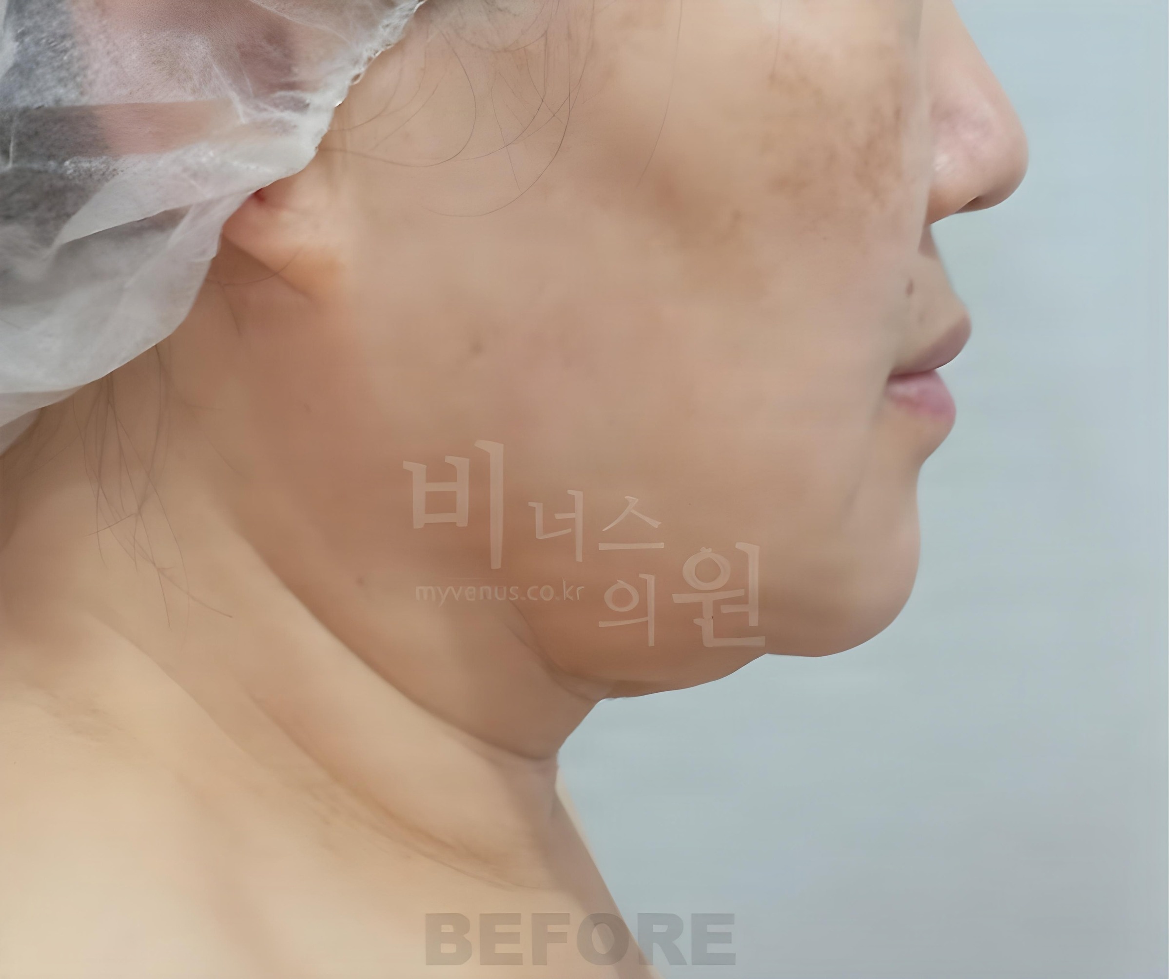 이중턱·턱라인 지방흡입 수술 전 반대편 측면 (50대 중후반 여성)