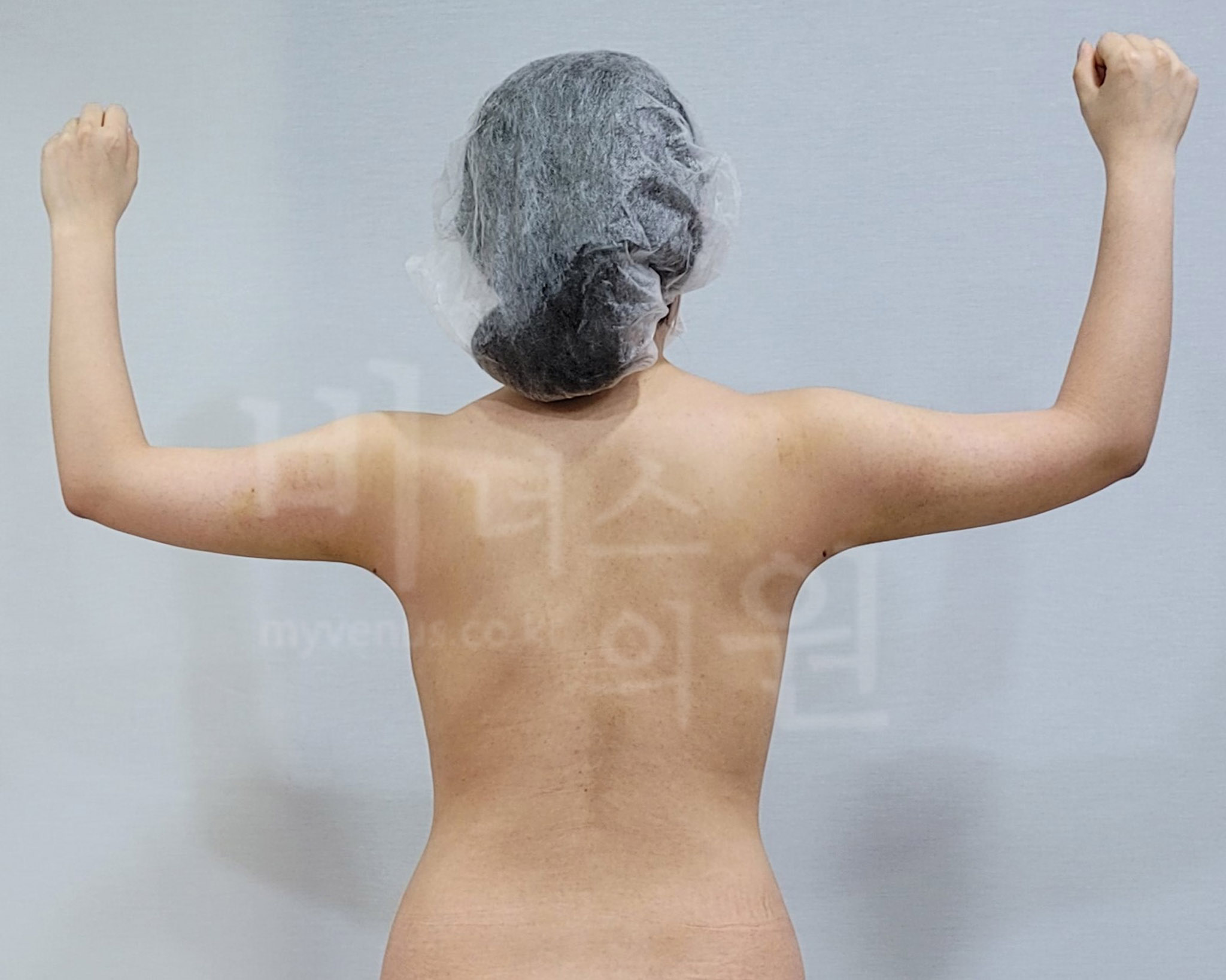 팔 지방흡입 수술 후 후면, 양팔을 굽혀 올린 자세 사진