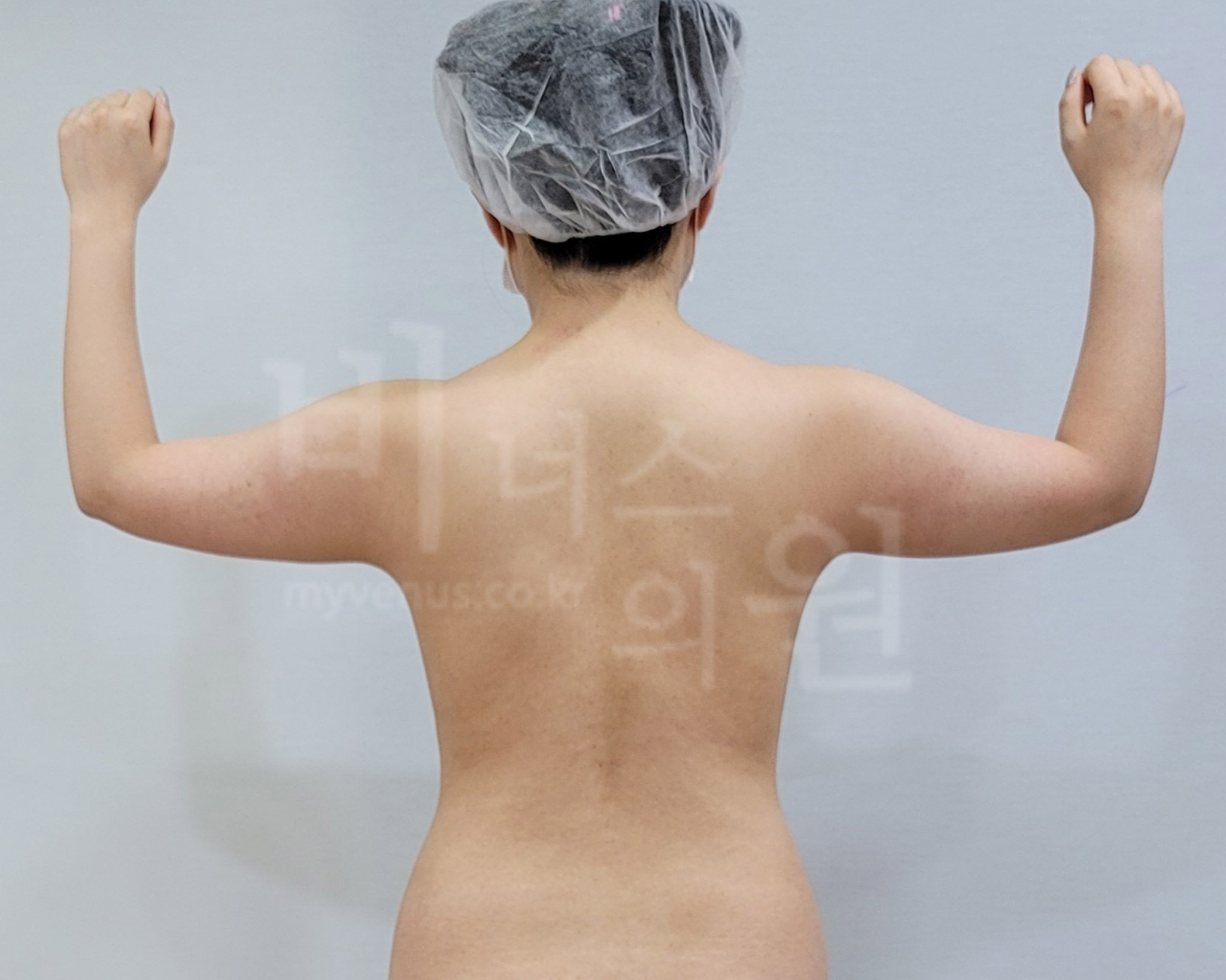 팔 지방흡입 수술 전 후면, 양팔을 굽혀 올린 자세 사진