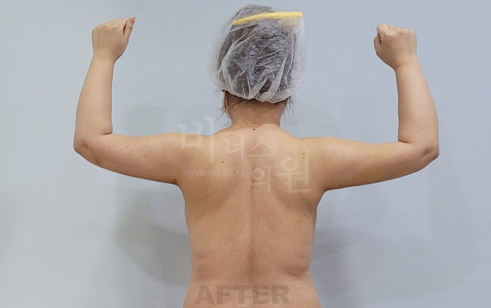 팔 지방흡입 후면, 양팔을 굽혀 올린 자세 사진 수술 후