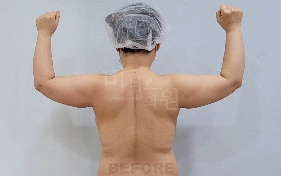 팔 지방흡입 후면, 양팔을 굽혀 올린 자세 사진 수술 전