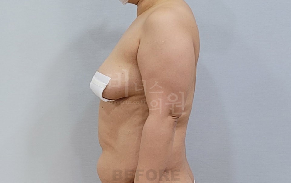 팔 지방흡입 측면 사진 수술 전