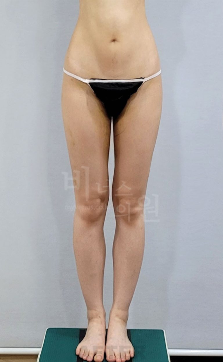 허벅지 지방흡입 뒤 붓기가 오래 갈까 걱정될 때 — 수술 범위·배액·압박복이 첫 한 달의 느낌을 바꾸는 이유