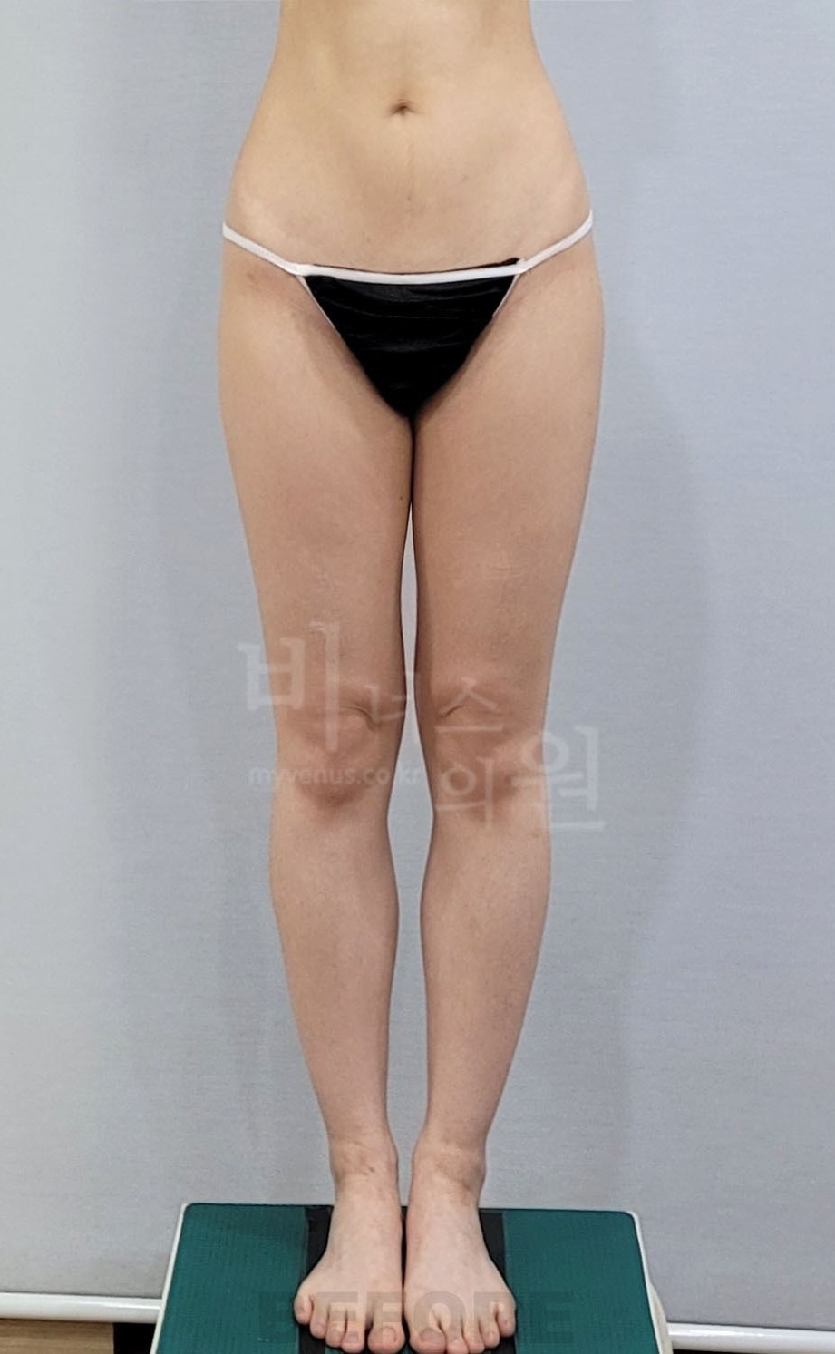허벅지 지방흡입 수술 전 정면 사진 1, 허벅지 바깥 윤곽과 두 다리 사이 간격