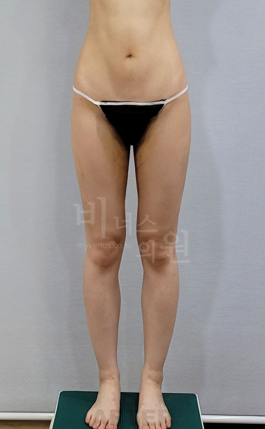 허벅지 지방흡입 수술 후 정면 사진 2, 같은 자세에서 허벅지 윤곽을 비교하는 모습