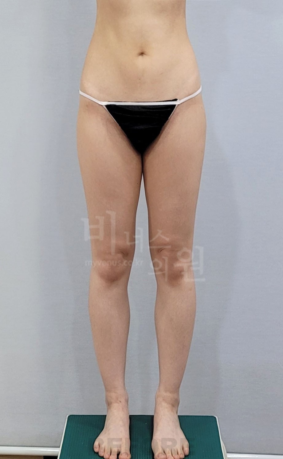 허벅지 지방흡입 수술 전 정면 사진 2, 같은 자세의 허벅지 윤곽