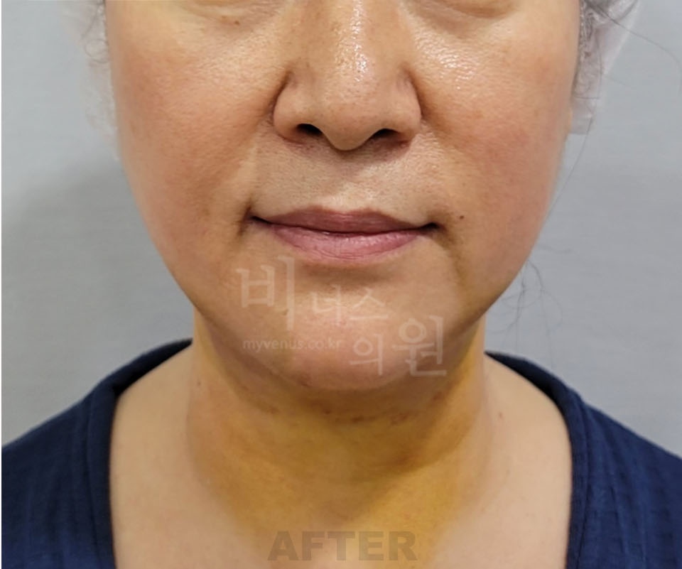 턱과 목 지방흡입 수술 후 정면 — 턱선과 목으로 이어지는 선