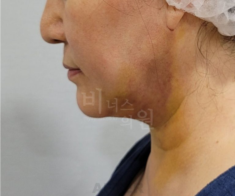 턱지방흡입 뒤 첫 4주, 달력 한 장으로 미리 걸어 보기 — 하루째·일주일째·한 달째 거울 앞에서 마주치는 장면들