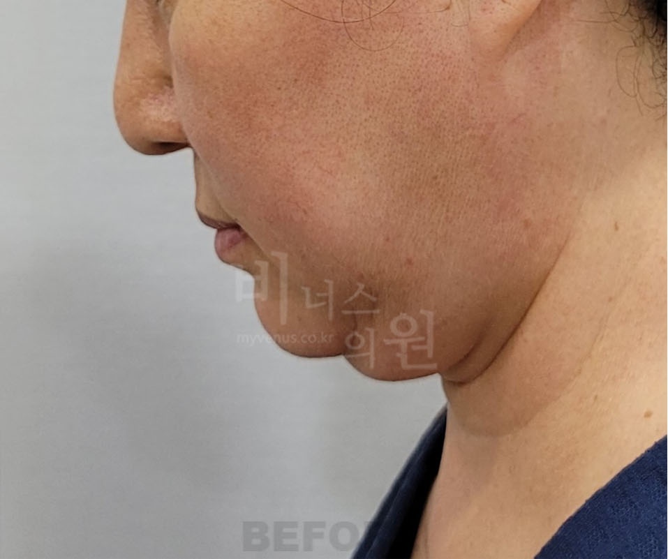 턱과 목 지방흡입 수술 전 좌측 측면 — 턱끝에서 목으로 이어지는 선