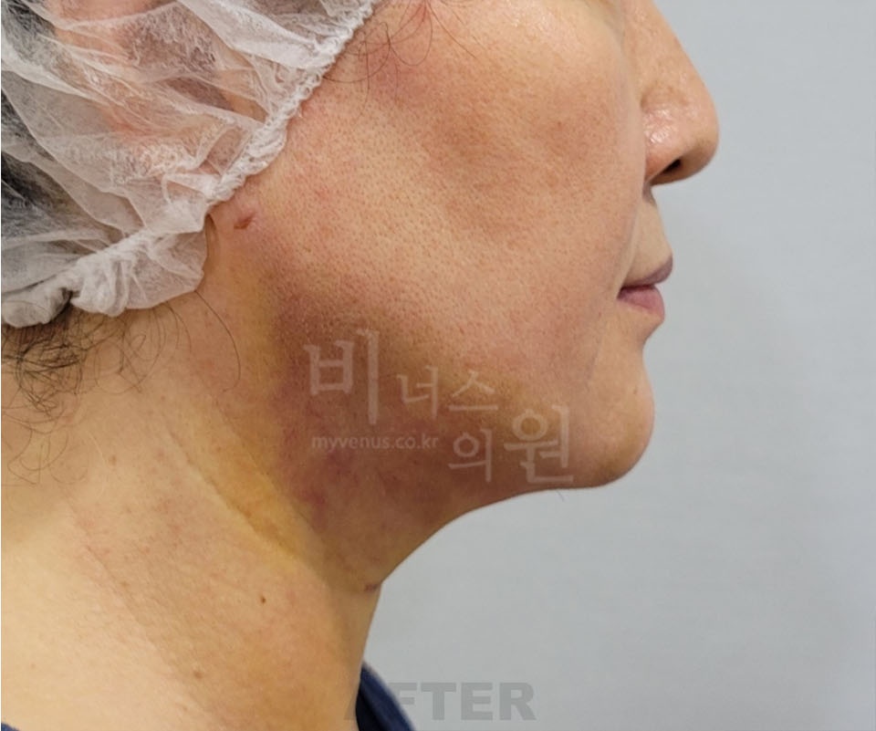 턱과 목 지방흡입 수술 후 우측 측면 — 턱 아래 두께와 목선