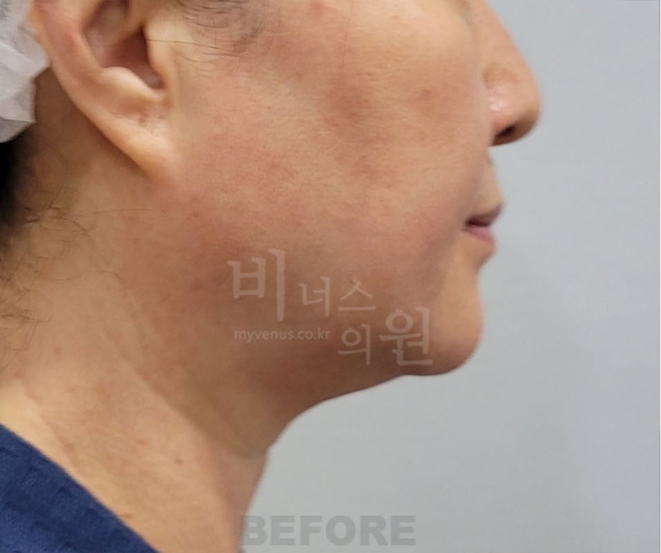 턱과 목 지방흡입 수술 전 우측 측면 — 턱 아래 두께와 목선