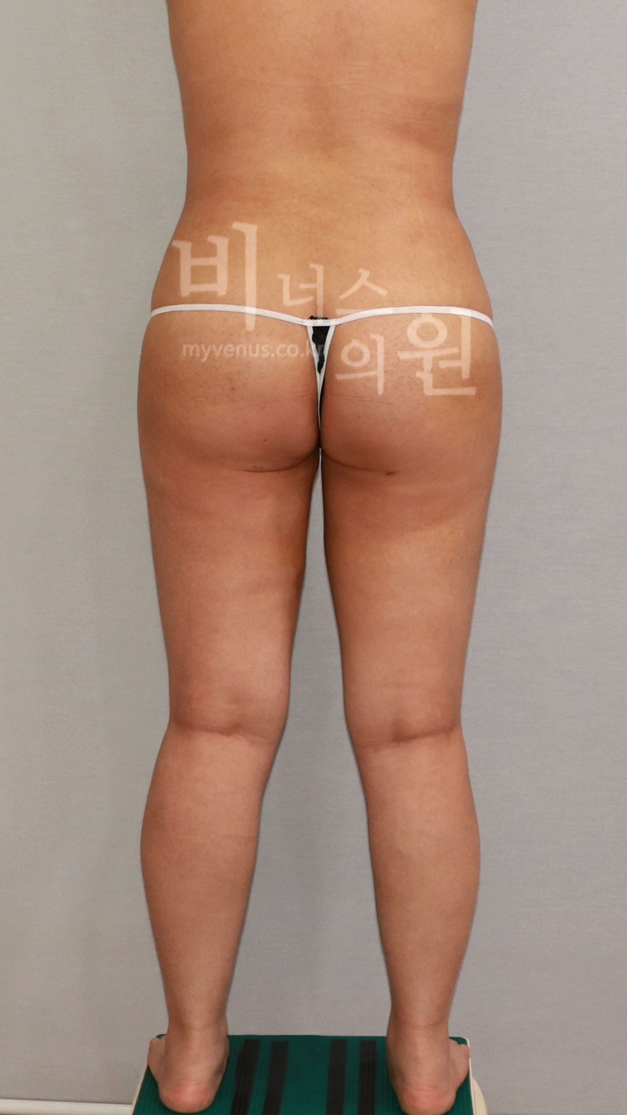 엉덩이 지방흡입 수술 후 후면 두 번째 — 엉덩이 모양 (2021년 촬영)