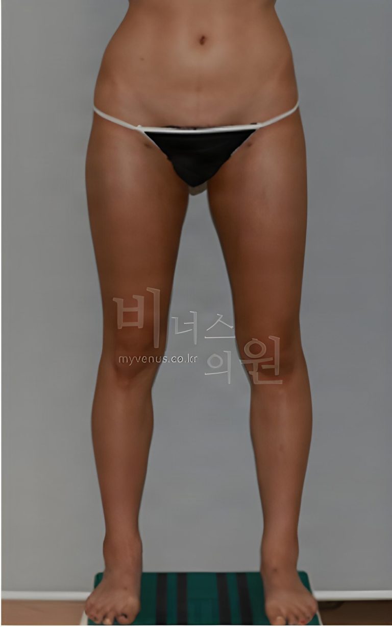 허벅지 지방흡입 뒤 거울 앞에 서면 어디부터 보게 될까 — 바깥 곡선·앞뒤 두께·엉덩이 아래·안쪽, 회복기에 확인하는 네 곳과 그 이유