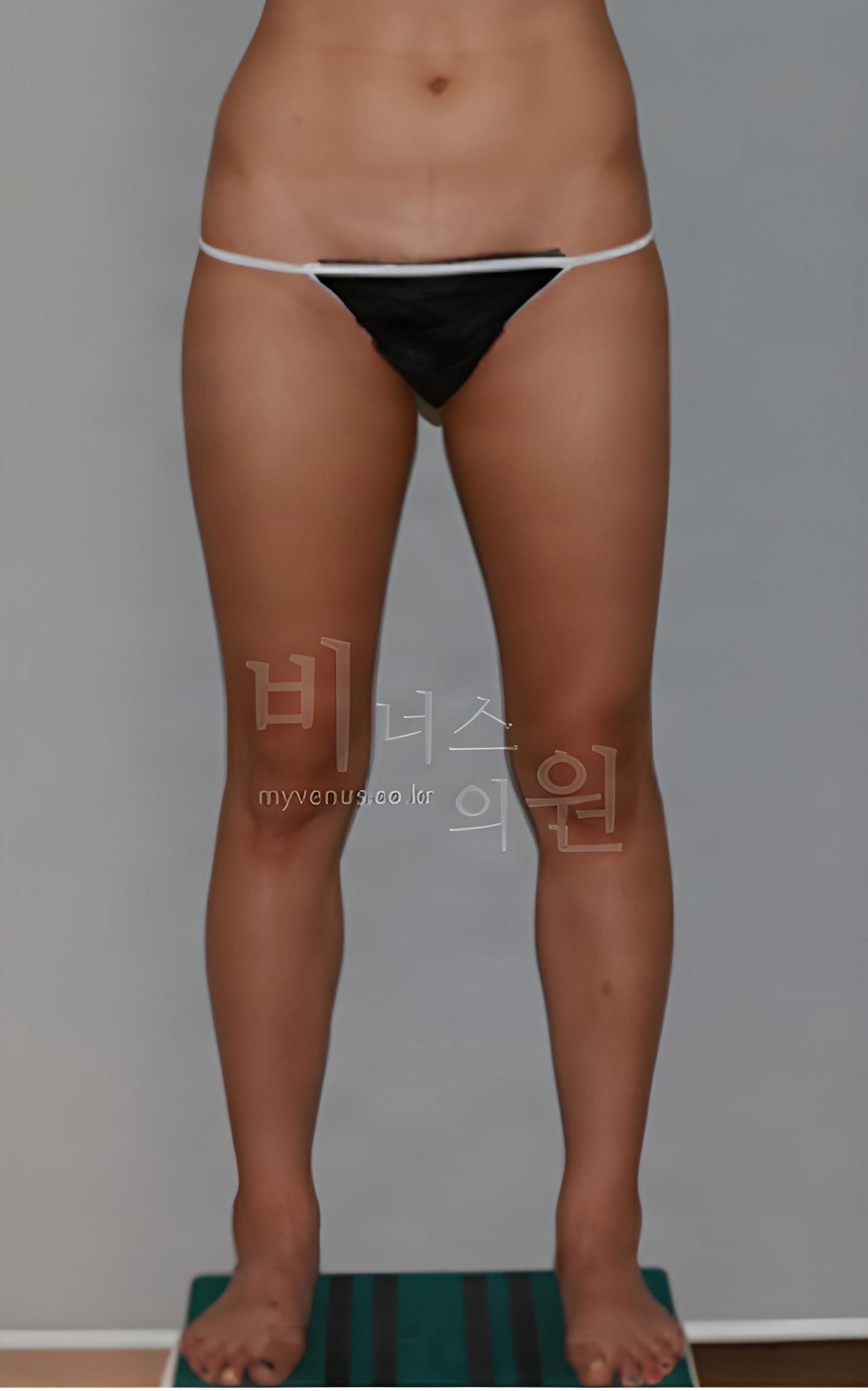허벅지 지방흡입 수술 전 정면 — 두 다리를 모으고 선 자세에서 허벅지 바깥 윤곽과 사이 간격