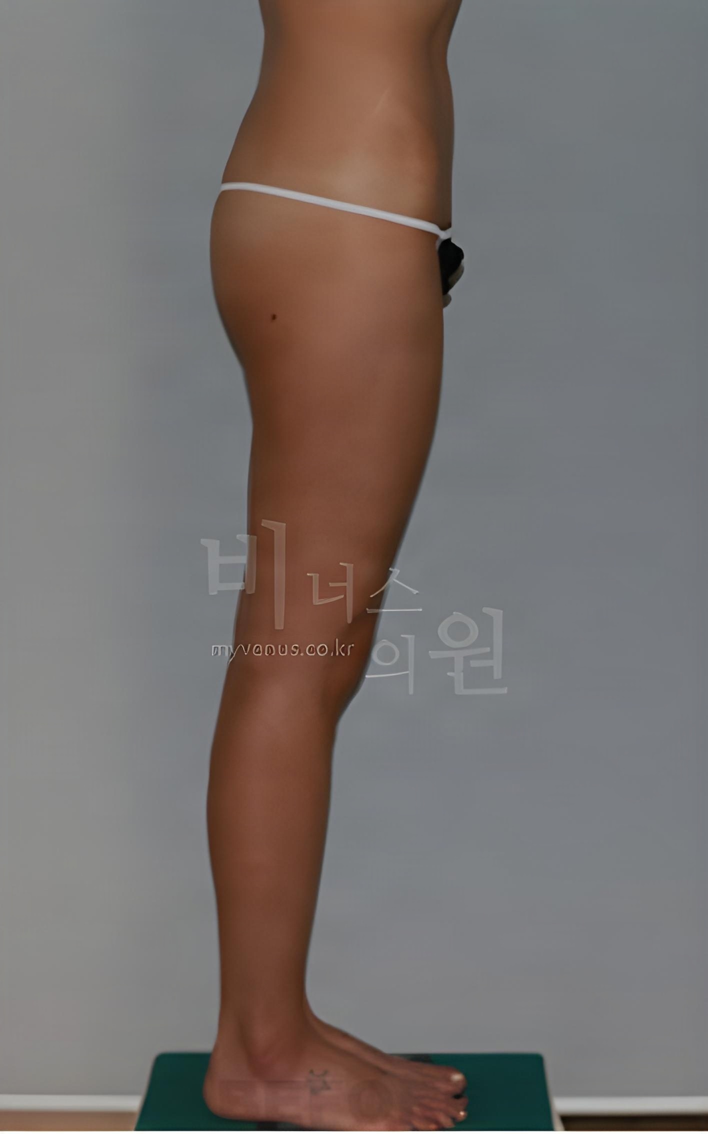 허벅지 지방흡입 수술 전 측면 — 엉덩이에서 허벅지 뒷면으로 이어지는 옆선