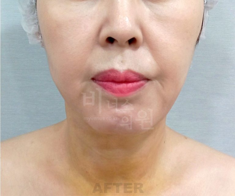턱지방흡입 회복에는 시계가 세 개 있습니다 — 붓기·딱딱함·피부 수축이 각자 다른 속도로 가는 이유