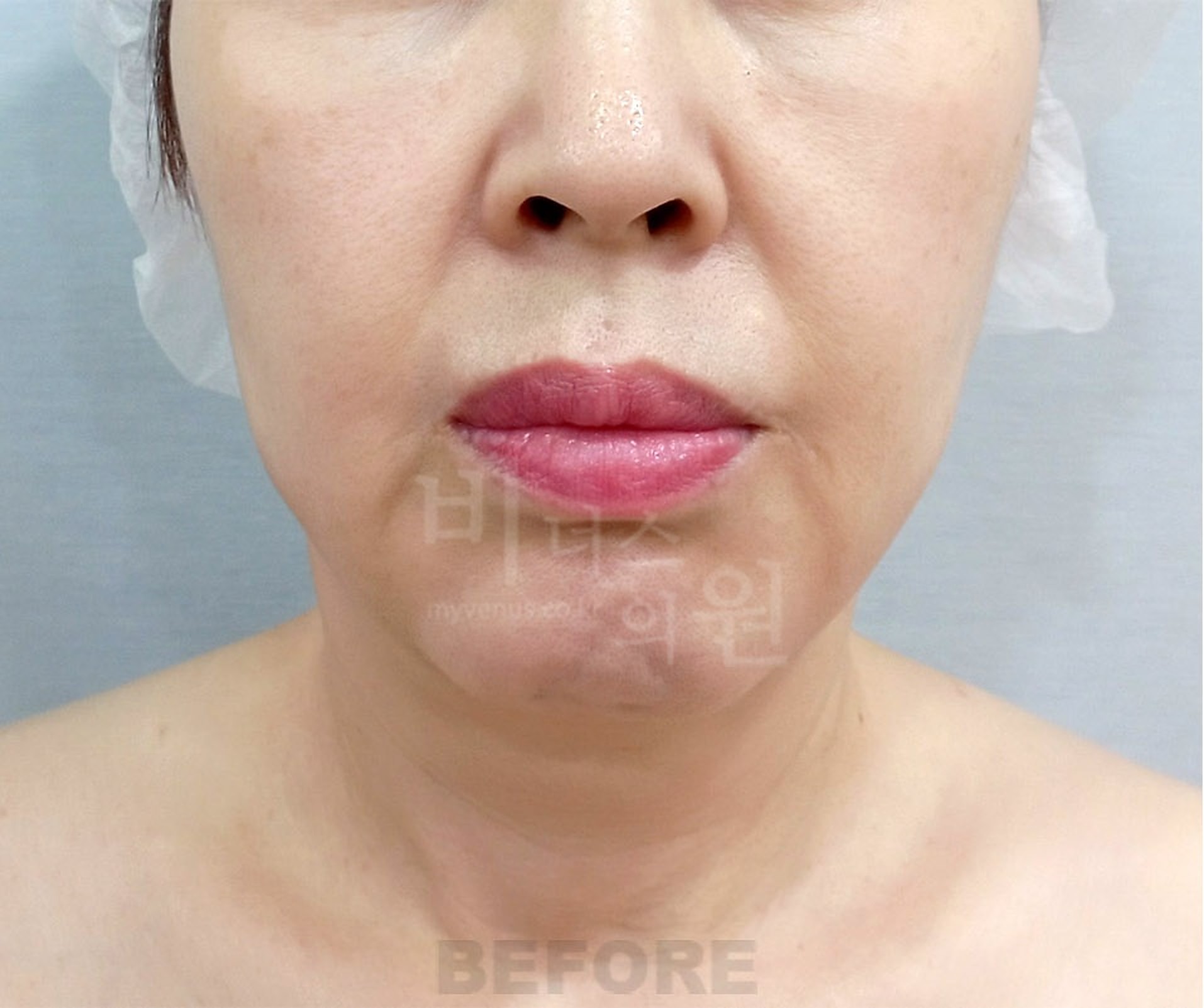 이중턱·목 지방흡입 정면 수술 전 사진 - 비너스의원 2026년 촬영 동일인, 수술 후 1주 경과
