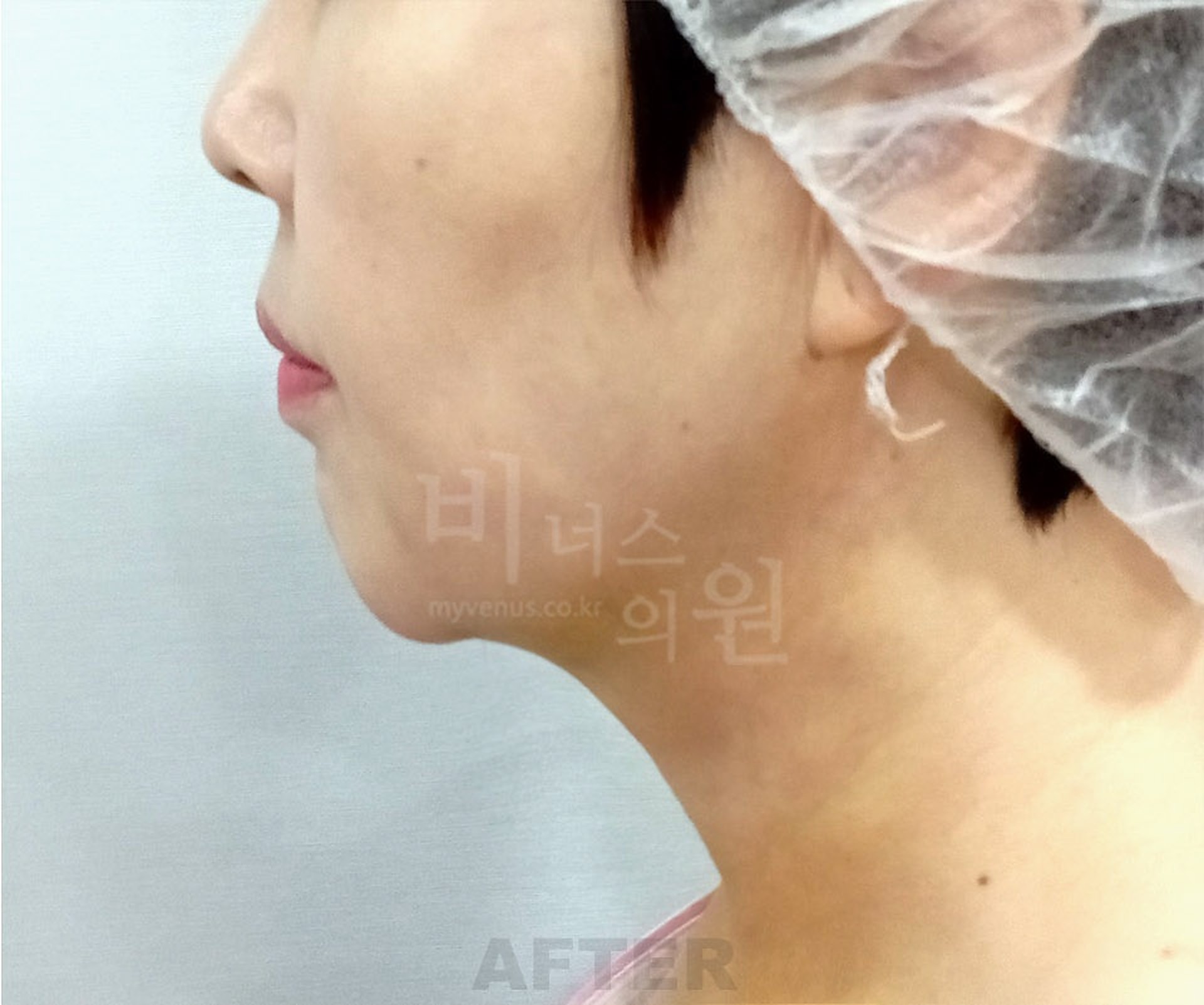 이중턱·목 지방흡입 좌측면 수술 후 사진 - 비너스의원 2026년 촬영 동일인, 수술 후 1주 경과