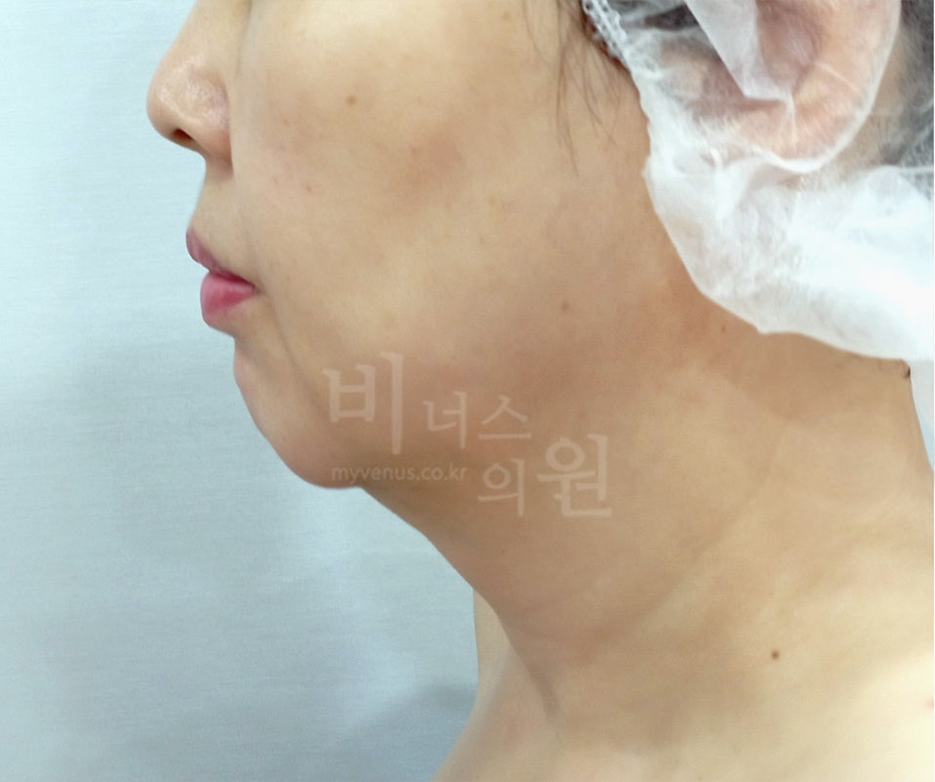 이중턱·목 지방흡입 좌측면 수술 전 사진 - 비너스의원 2026년 촬영 동일인, 수술 후 1주 경과