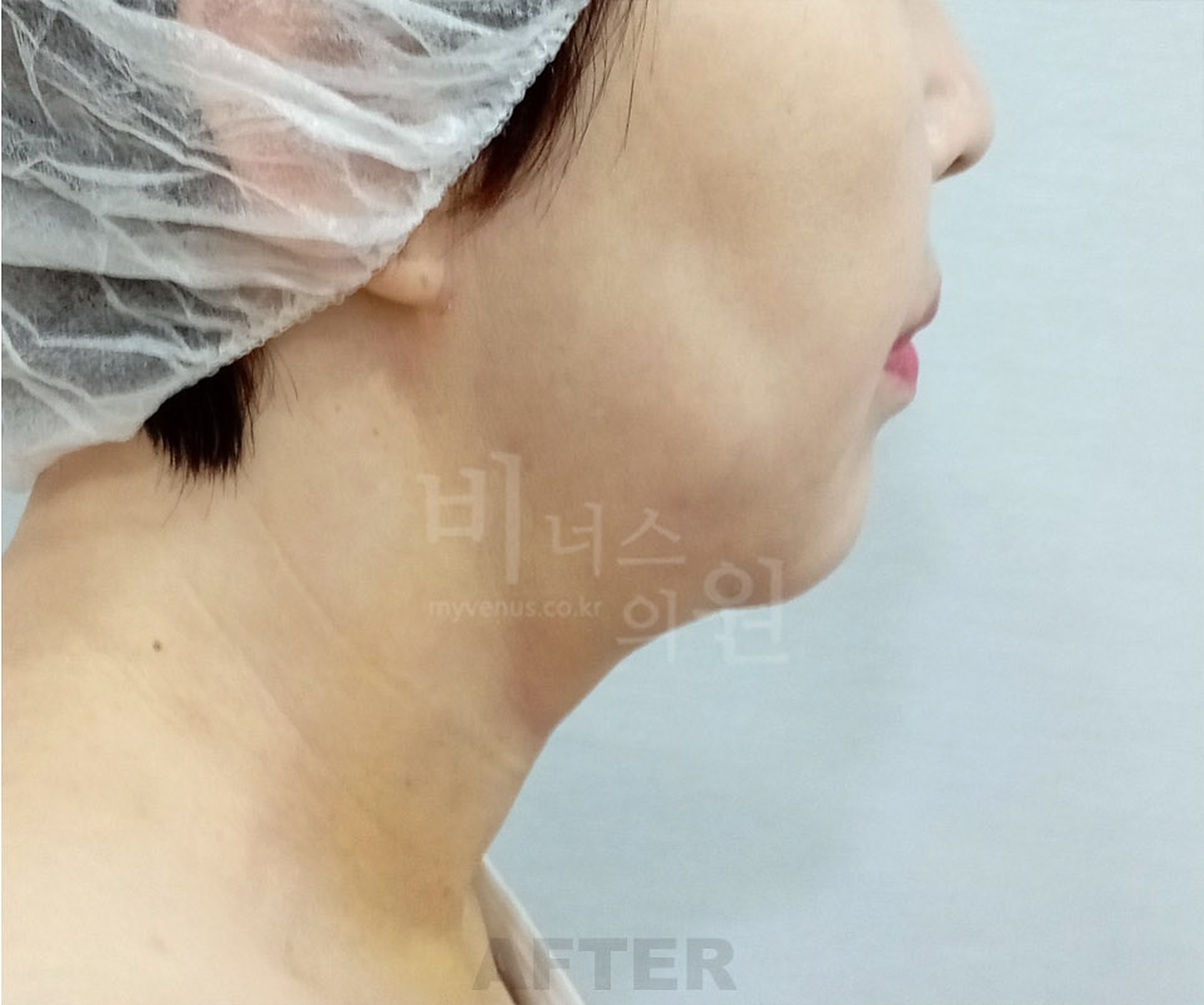 이중턱·목 지방흡입 우측면 수술 후 사진 - 비너스의원 2026년 촬영 동일인, 수술 후 1주 경과