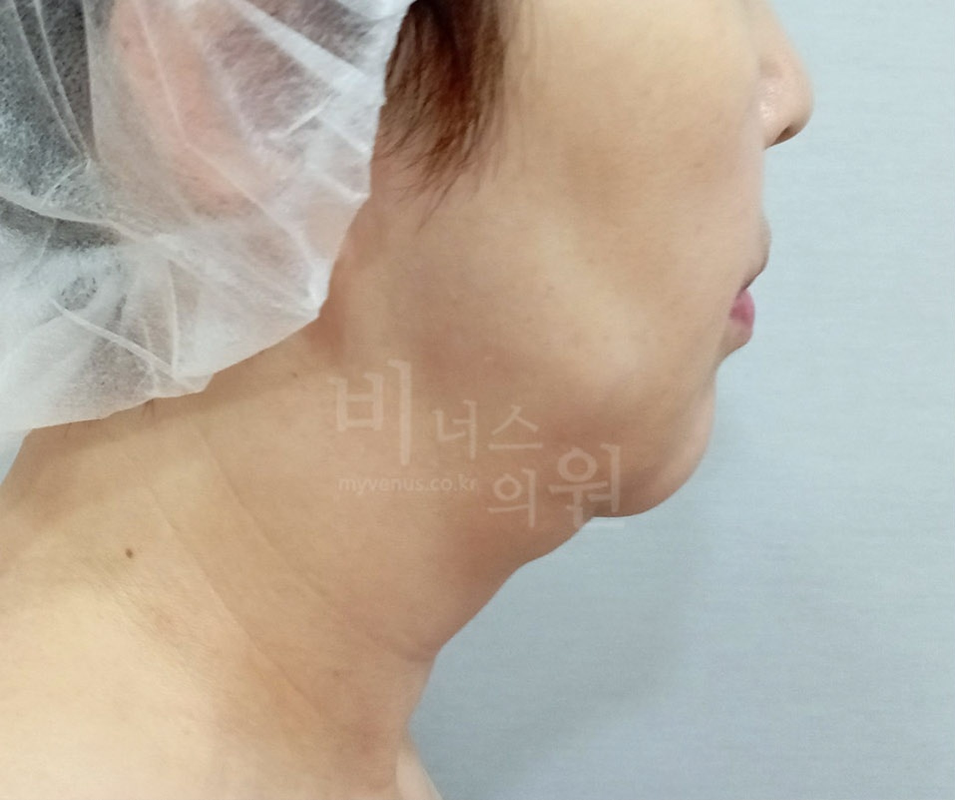 이중턱·목 지방흡입 우측면 수술 전 사진 - 비너스의원 2026년 촬영 동일인, 수술 후 1주 경과