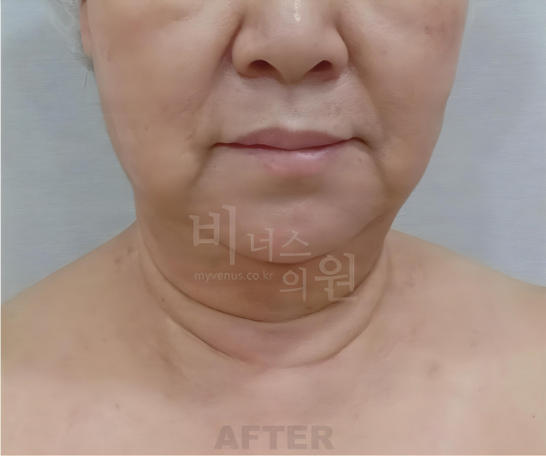 볼·턱·목·이중턱 지방흡입 정면 수술 후 1주 경과 사진 — 60대 중반, 비너스의원 2023년 촬영