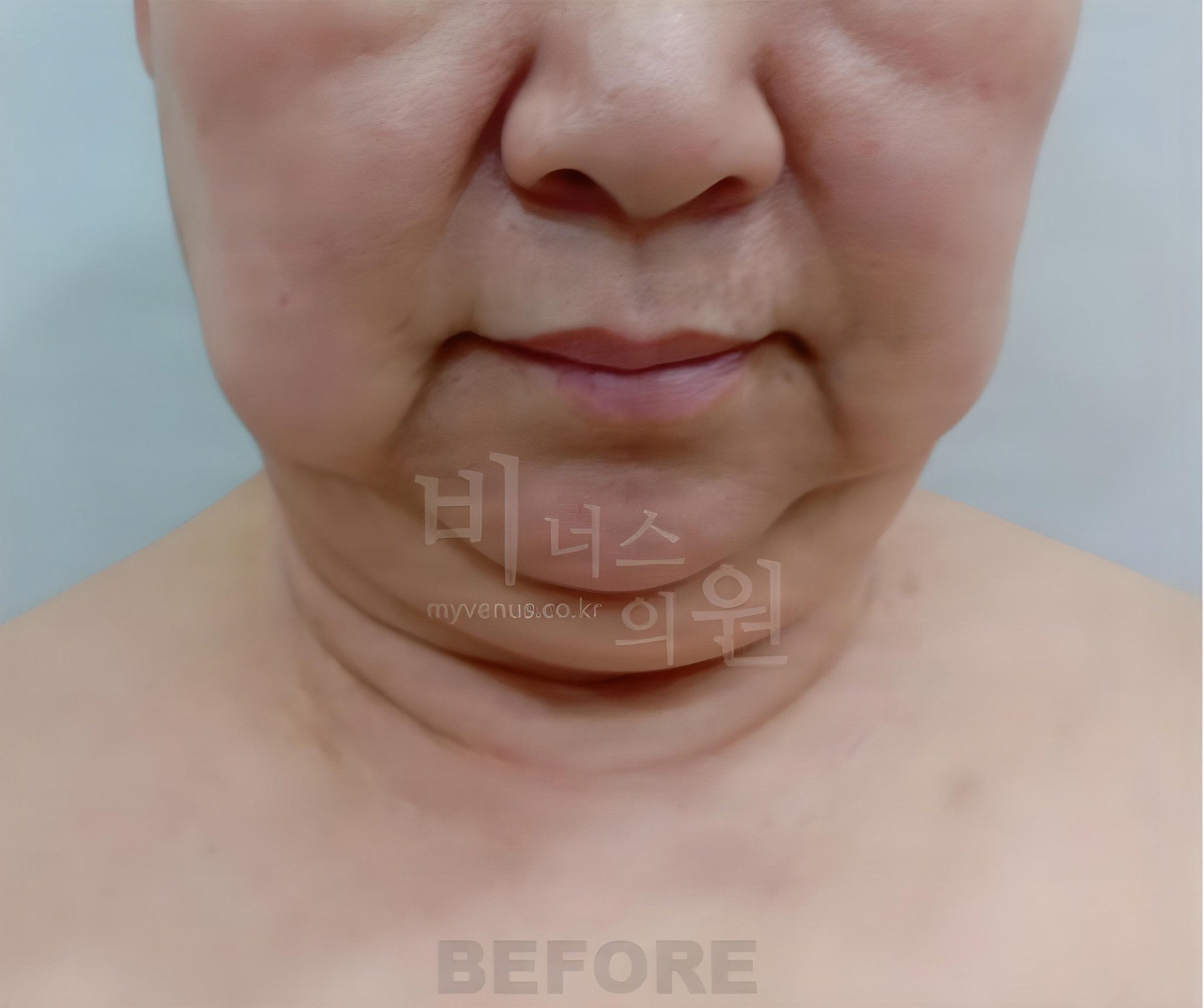 볼·턱·목·이중턱 지방흡입 정면 수술 전 사진 — 60대 중반, 비너스의원 2023년 촬영