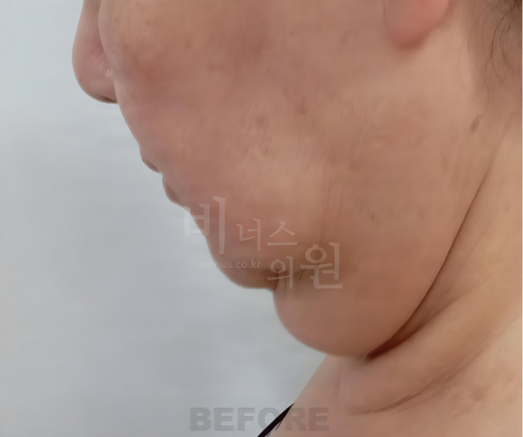 볼·턱·목·이중턱 지방흡입 측면 수술 전 사진 — 60대 중반, 비너스의원 2023년 촬영