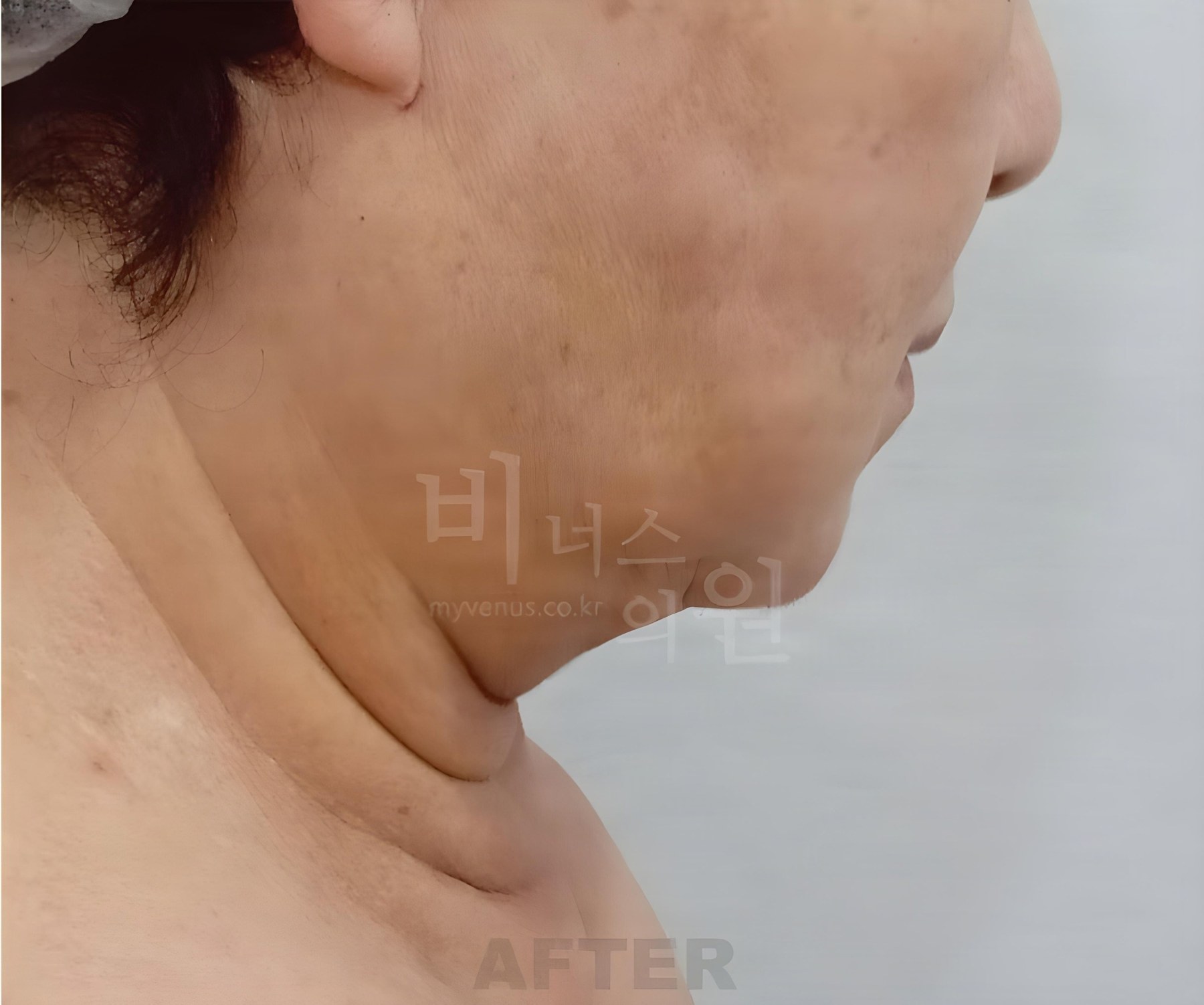 볼·턱·목·이중턱 지방흡입 반대쪽 측면 수술 후 1주 경과 사진 — 60대 중반, 비너스의원 2023년 촬영