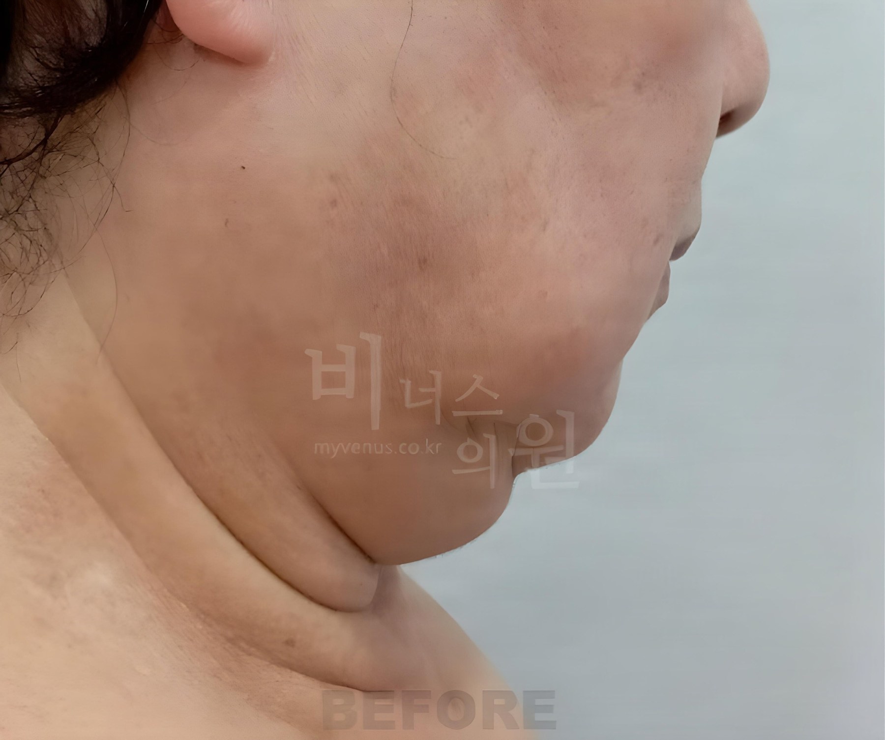 볼·턱·목·이중턱 지방흡입 반대쪽 측면 수술 전 사진 — 60대 중반, 비너스의원 2023년 촬영