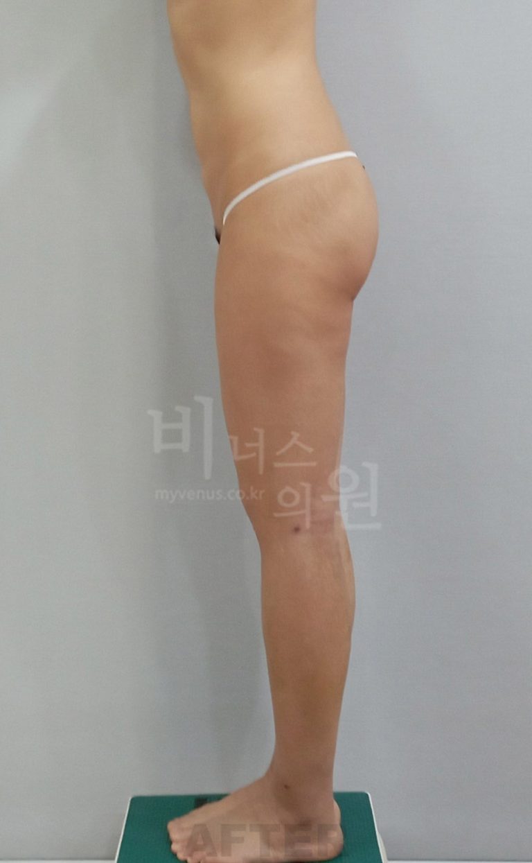 엉덩이축소 지방흡입 후 마주하는 낯선 변화들 — 단단함, 울긋불긋한 피부, 무딘 감각의 이유