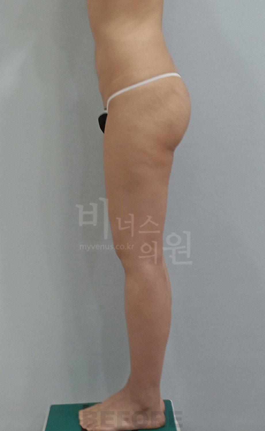 엉덩이 지방흡입 우측면 수술 전 사진 - 비너스의원 2022년 촬영 동일인